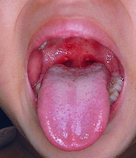 中医治疗手足口病最佳方法,中医辨证手足口病