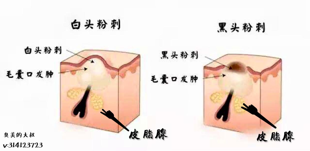 怎么去除黑头白头,面部黑头白头粉刺