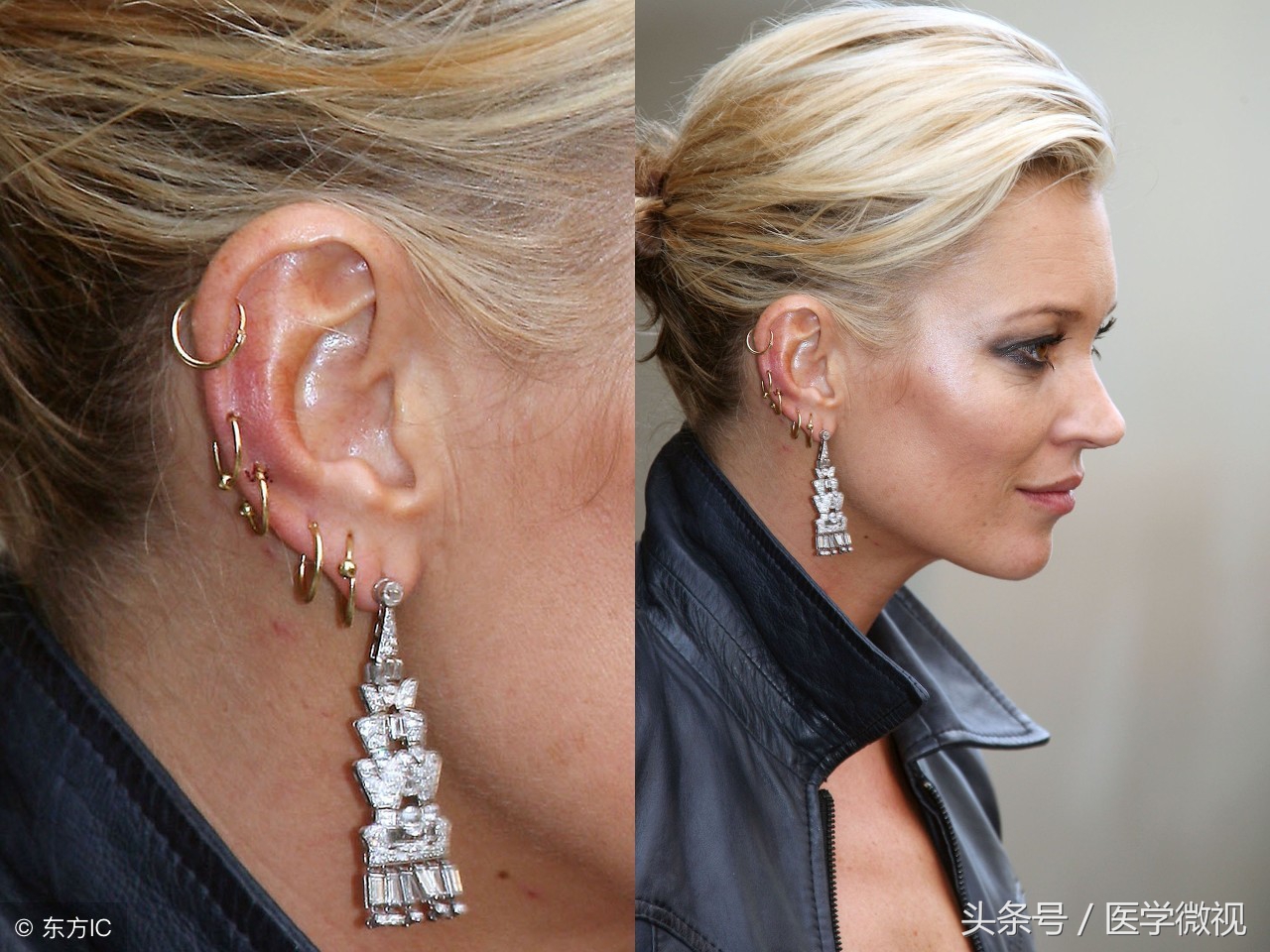 中医讲打耳洞的好处,打耳洞有利于视力