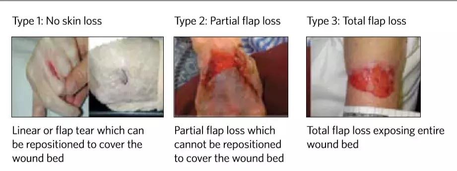 皮肤撕伤怎么快速恢复,撕过表皮的皮肤怎么护理
