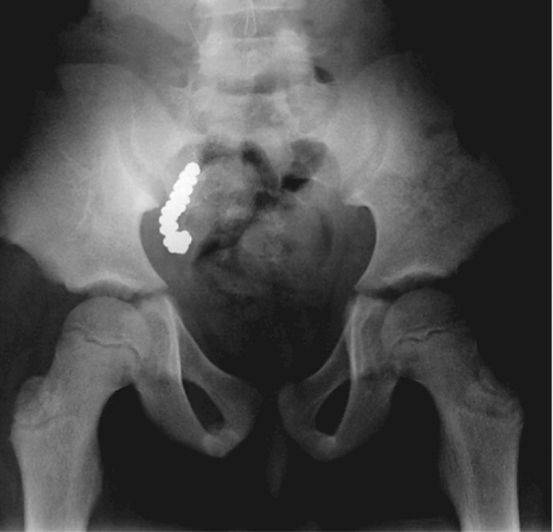 阴茎纹身还有这用处？医生应该见识的22个奇葩病例