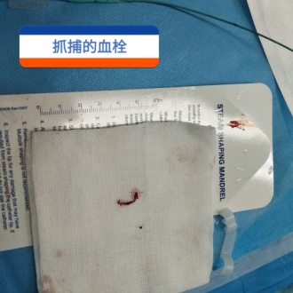 兰州石化总医院卒中中心成功救治一名昏迷脑卒中患者