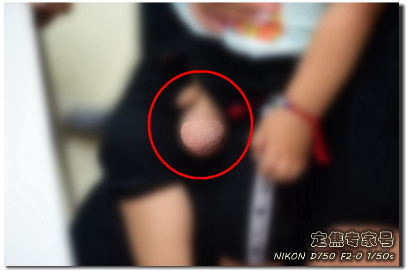 医生告知宝宝一侧*丸睾**扭转坏死，宝妈却扭头让宝宝叫旁边孩子哥哥