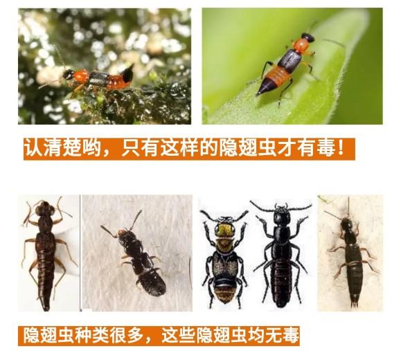 隐翅虫咬人症状图片,隐翅虫咬人症状最初图片