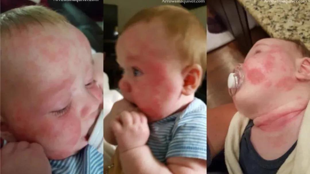 得湿疹了自己会好吗,得了湿疹要忌什么