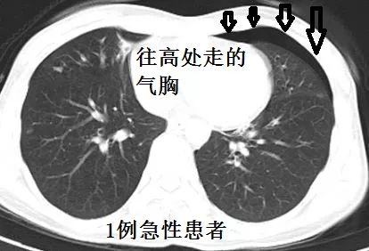 这样的气胸不少见,胸腔穿刺需谨慎!