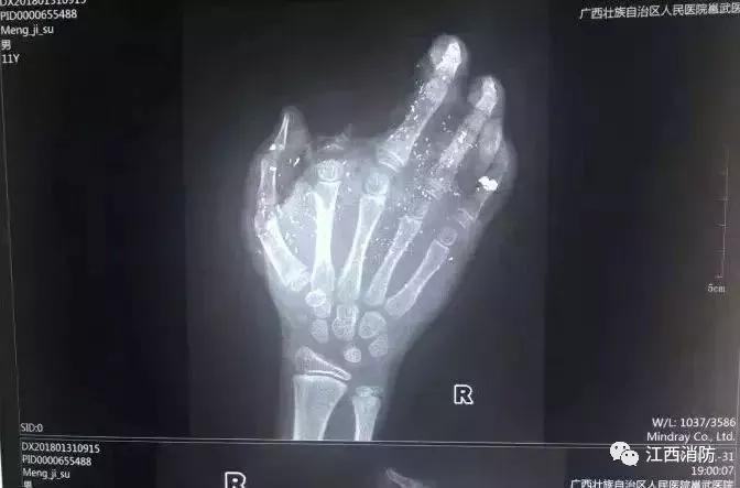 男子把手机放在枕头下面导致爆炸,男子睡觉时手机爆炸