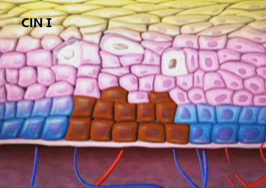 宫颈癌前病变不用怕，及时发现早治疗