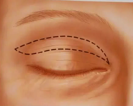 双眼皮是怎么搞的,双眼皮是怎么弄出来的
