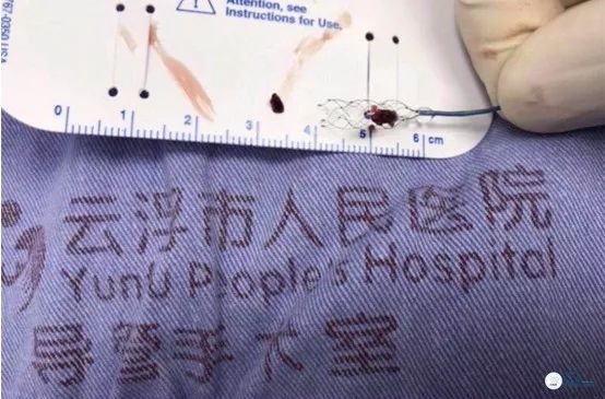 基底动脉闭合手术,基底动脉闭塞取栓一直昏睡