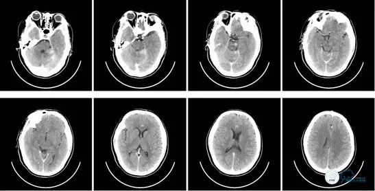 基底动脉闭合手术,基底动脉闭塞取栓一直昏睡