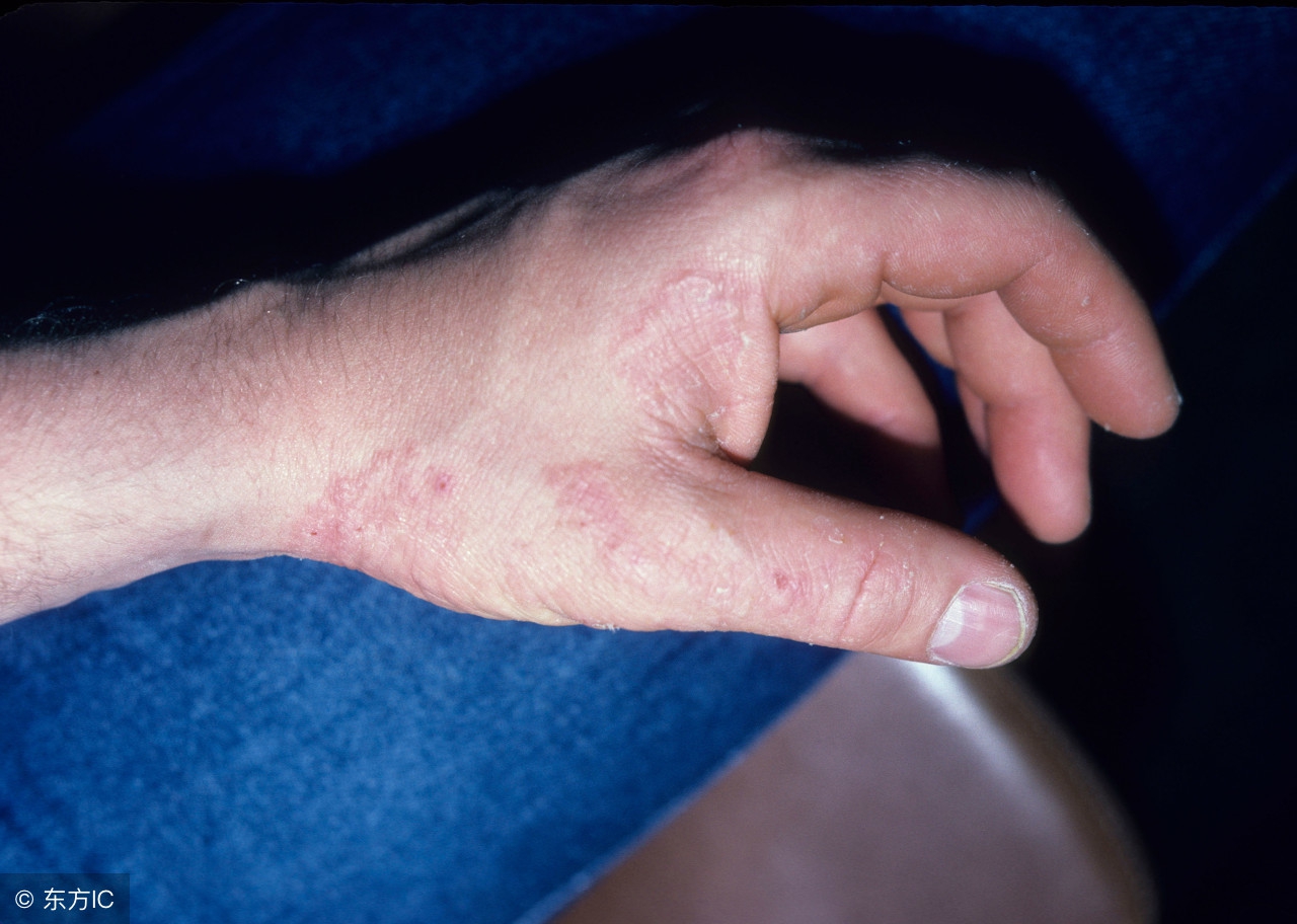 发现有灰指甲的预兆怎么防治,灰指甲中医可以诊断吗