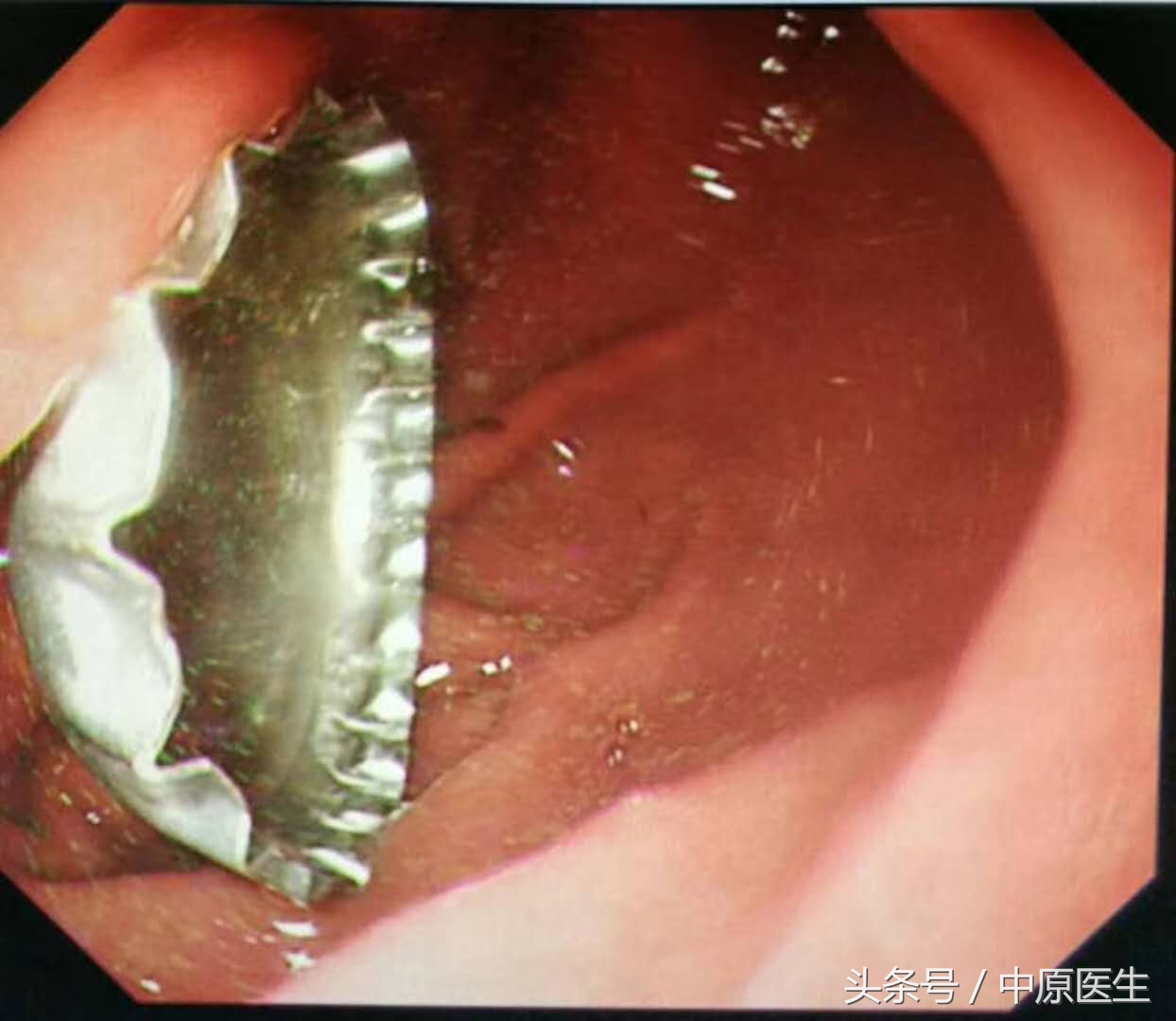 让人脑洞大开的“套套”用法：专家把男子喝到胃里的啤酒盖取出