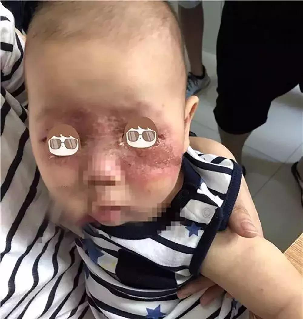 夏季到了,如何预防隐翅虫皮炎?