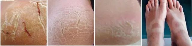 擦掉一块皮用什么药,擦掉了一小块皮一般需要多久恢复