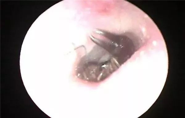 常德女子突然头晕头痛还耳鸣，竟然是这种生物在耳内“安家”了！