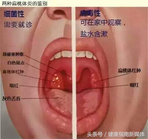7岁小孩扁桃体肿大要切除吗,扁桃体2到3度肿大需要切除吗