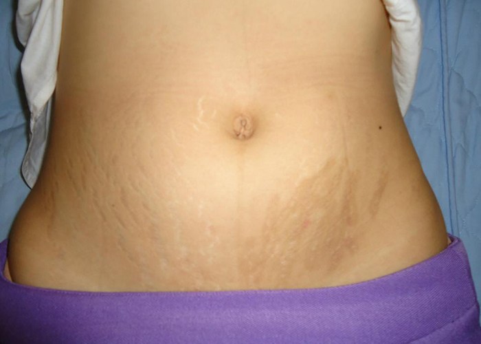 教你一招搞定妊娠纹,妊娠纹有没有人去掉过