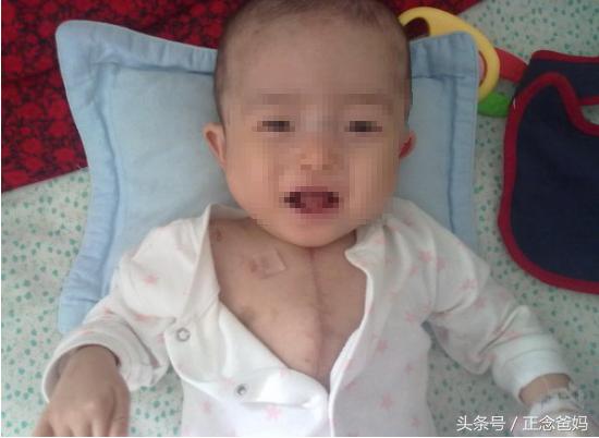 宝宝胸口上方鼓鼓的,儿童胸口鼓起来