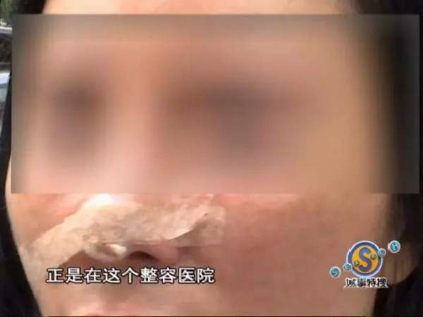 女子花9万元整容结果,女子花费9万多元整容整成歪鼻子
