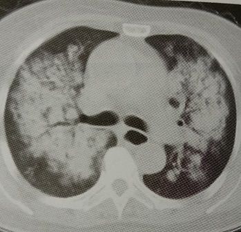 肺水肿和左心衰如何鉴别诊断,蝶翼征