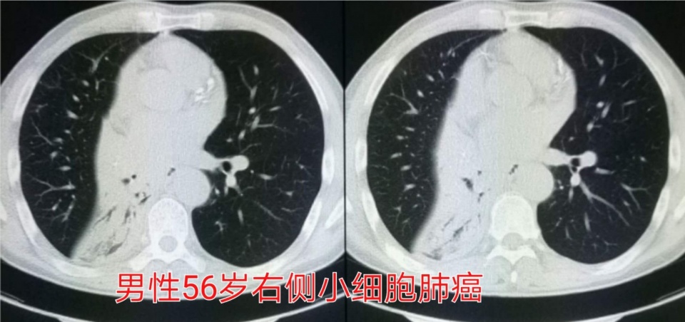 治疗癌症的靶向药能不能停,靶向治疗药物任何癌症都可以吃吗