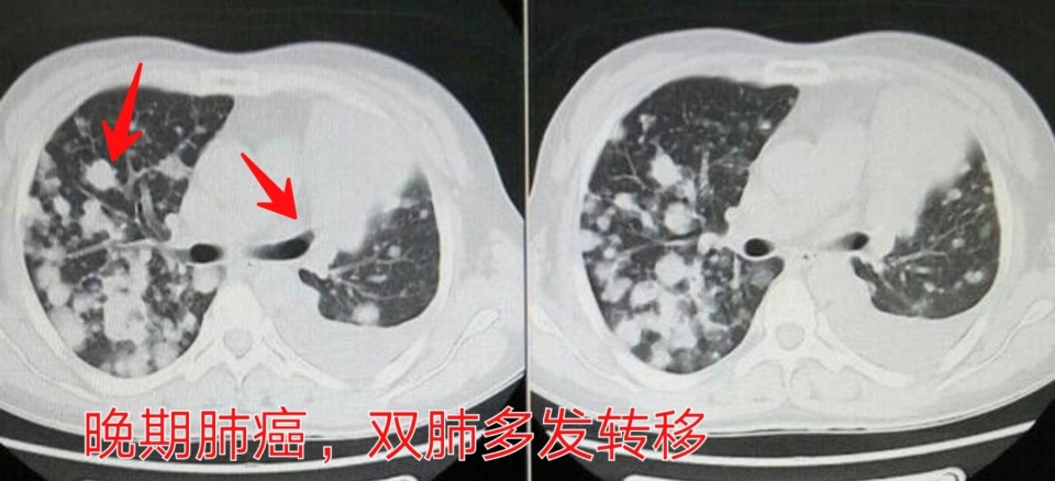 治疗癌症的靶向药能不能停,靶向治疗药物任何癌症都可以吃吗