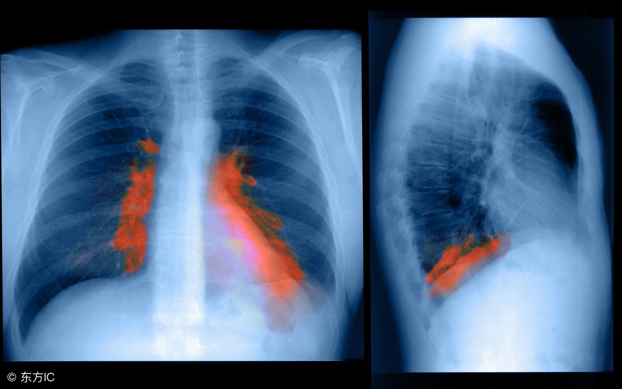 检查出肺部有黑影是什么状况,肺部条索状高密度影肺癌的几率