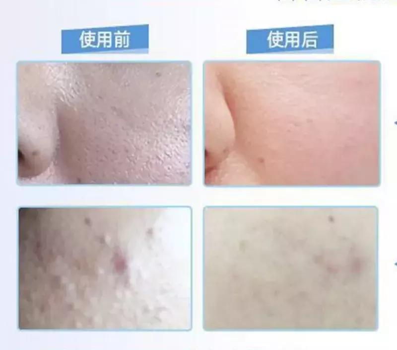 亲试十大祛痘药,亲测各类祛痘印护肤品