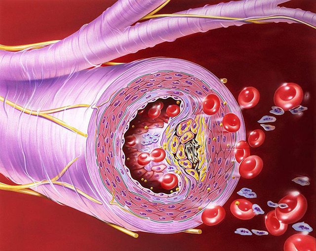 什么人需要查颈动脉彩超,哪些人需要检测血糖