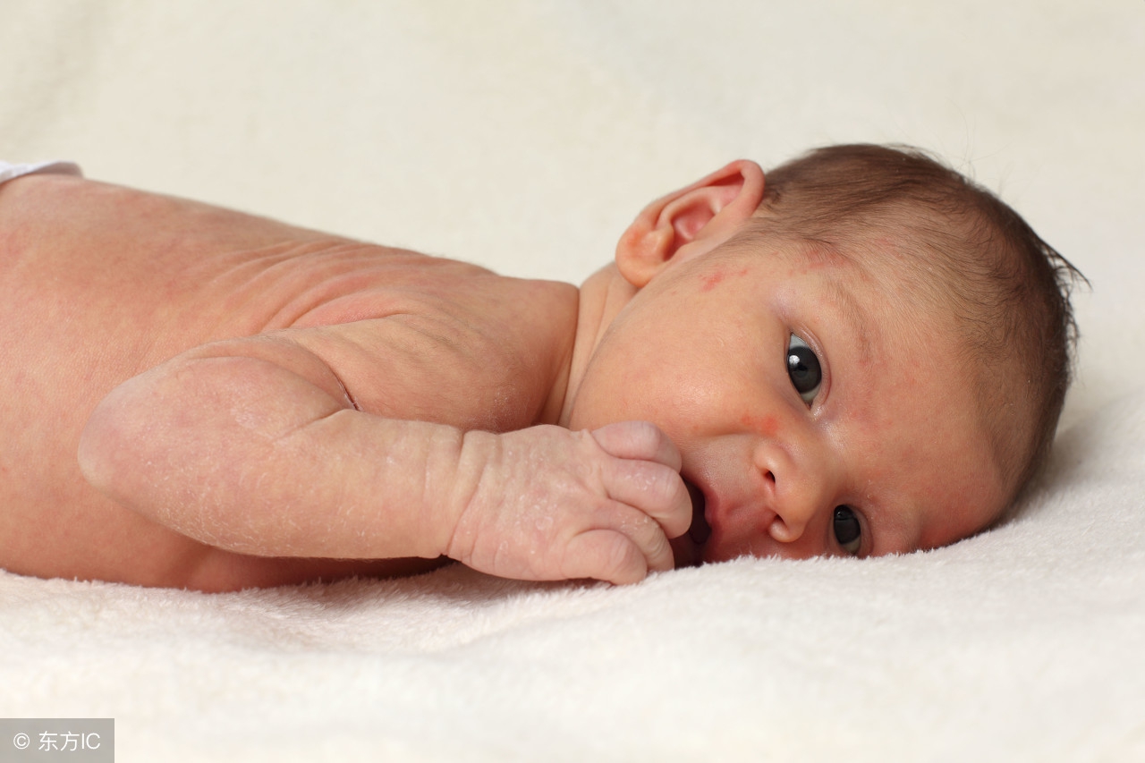 夏季湿疹怎么治疗用啥药,夏季湿疹多吃三瓜喝二粥