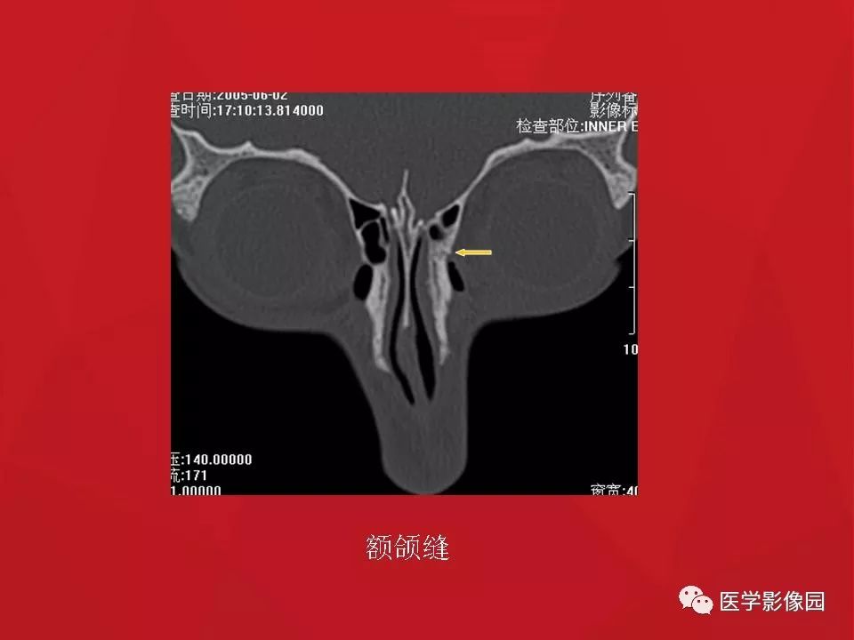 左侧鼻骨骨折伴鼻中隔骨折,双侧鼻骨及左上颌骨突骨折