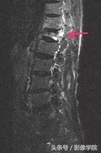 骨质疏松引起的老年性腰椎骨折,胸11椎体压缩性骨折怎么治疗