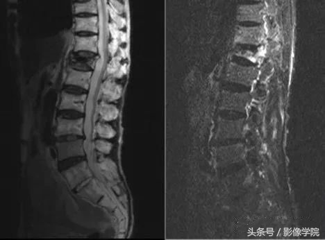 骨质疏松引起的老年性腰椎骨折,胸11椎体压缩性骨折怎么治疗