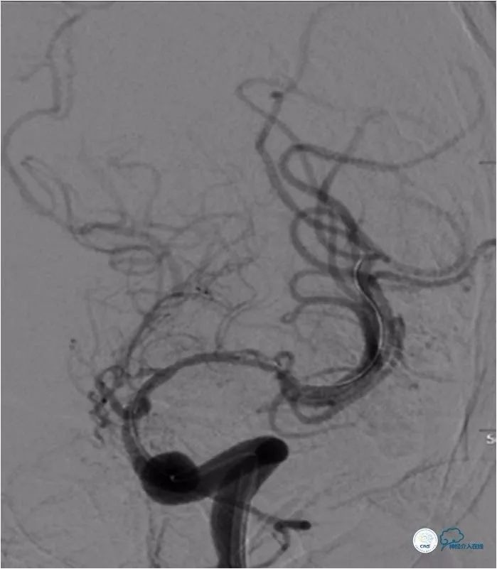 大脑中动脉支架术后再狭窄的几率,天坛医院介入脑血管手术