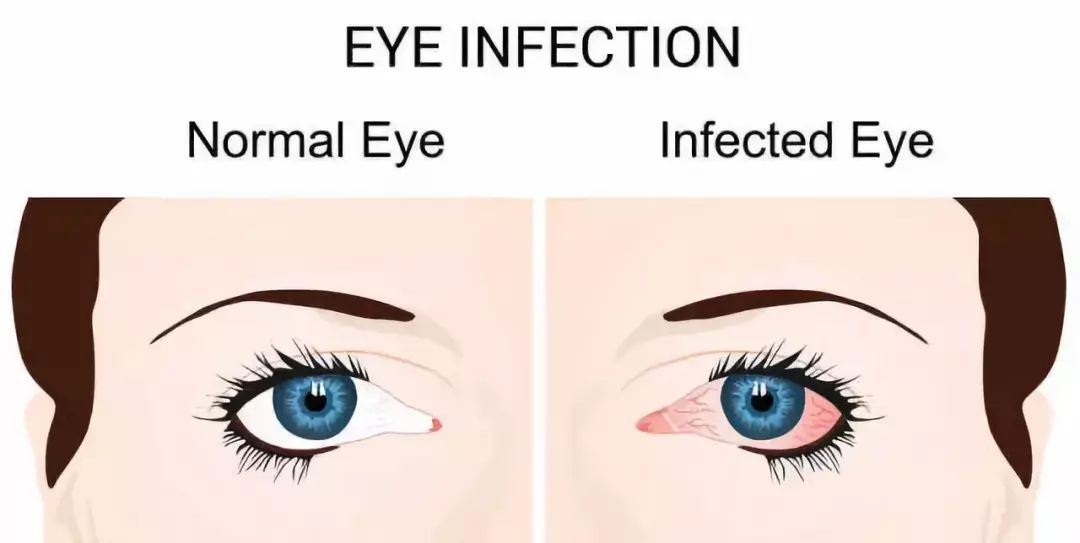 眼睛患结膜炎红肿发痒，别乱滴眼药水