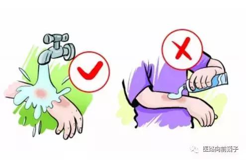 烫伤了怎么办动画片,烫伤了怎么办最快解决方法