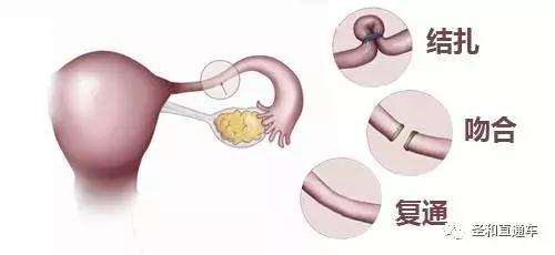 结扎后做复通手术多久可以怀孕呢,结扎后还想要孩子可以试管吗