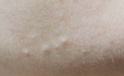 颜悦课堂洗脸可以祛痘吗,颜悦课堂的真实案例