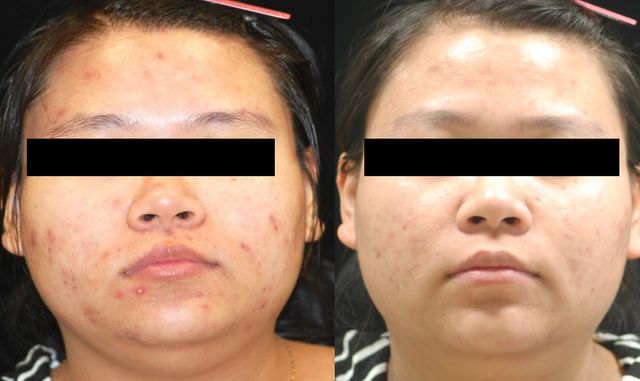 颜悦课堂的真实故事,颜悦课堂洗脸可以祛痘吗