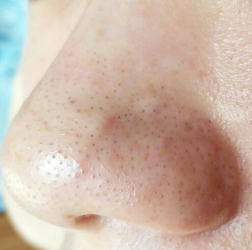 鼻子有黑头不用挤教你一招,鼻子挤黑头留下的小洞怎么收缩