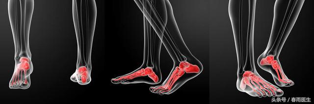 穿高跟鞋扭伤脚踝怎么处理,穿高跟鞋怕崴脚怎么办