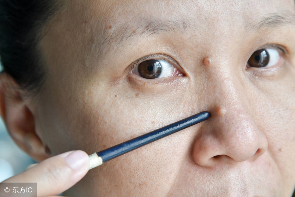 点痣的危害与副作用为什么会长痣,点痣有哪些注意事项