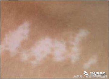 怎么判断孩子斑点是不是白癜风,宝宝身上长白斑是缺什么
