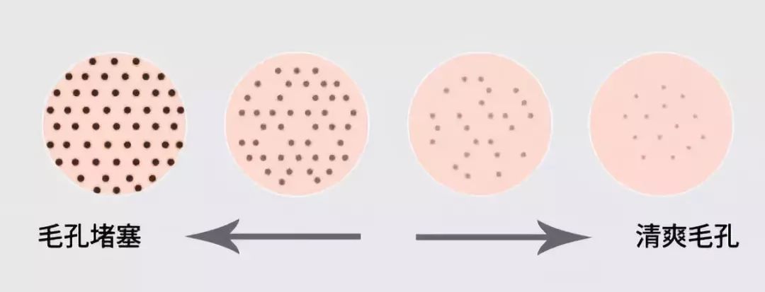 皮肤科科学去黑头的方法,三甲医生教你去黑头
