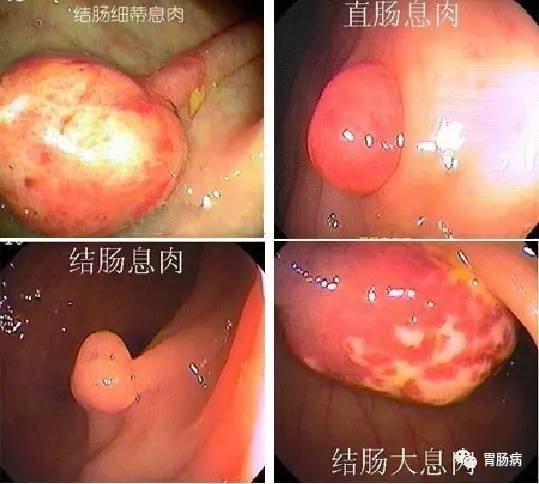 结直肠癌的引发原因,大肠肿瘤和直肠癌哪个严重