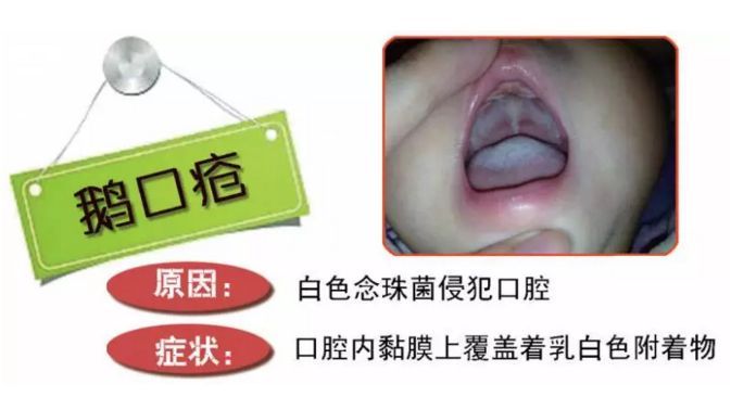 新生儿鹅口疮怎么预防和处理,新生儿鹅口疮引起的原因是什么