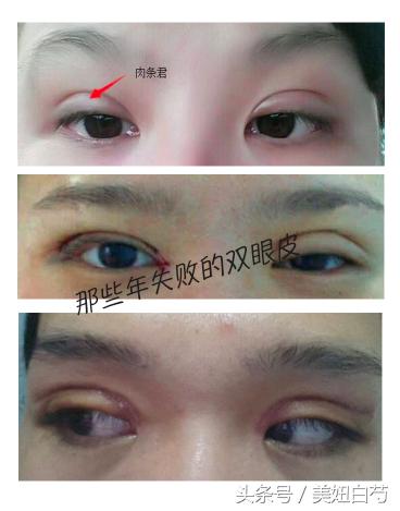 双眼皮埋线的亲身经历,对要做双眼皮埋线的几个建议