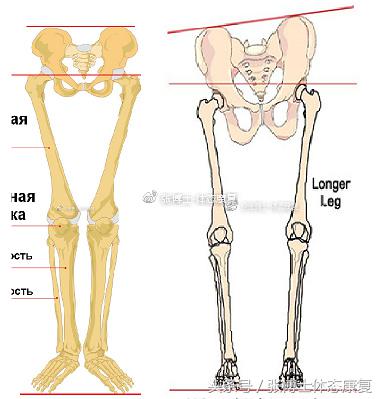 矫正长短腿去哪里矫正,体态矫正腿