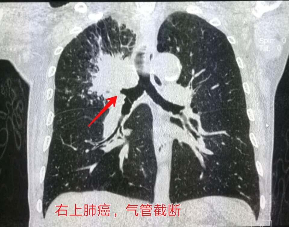 吸烟有害为什么有人能活到90多岁,为什么有的人吸烟寿命更长